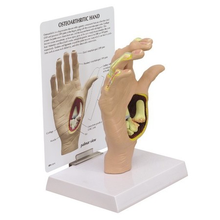 GPI ANATOMICAL Anatomical Model - Hand - Osteoarthritis 1930